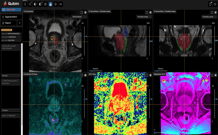 A picture of the Quibim QP Prostate platform